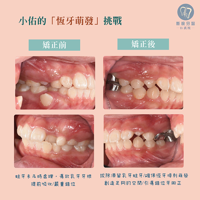 兒童矯正困難案例｜小佑的恆牙萌發挑戰的第3張圖片